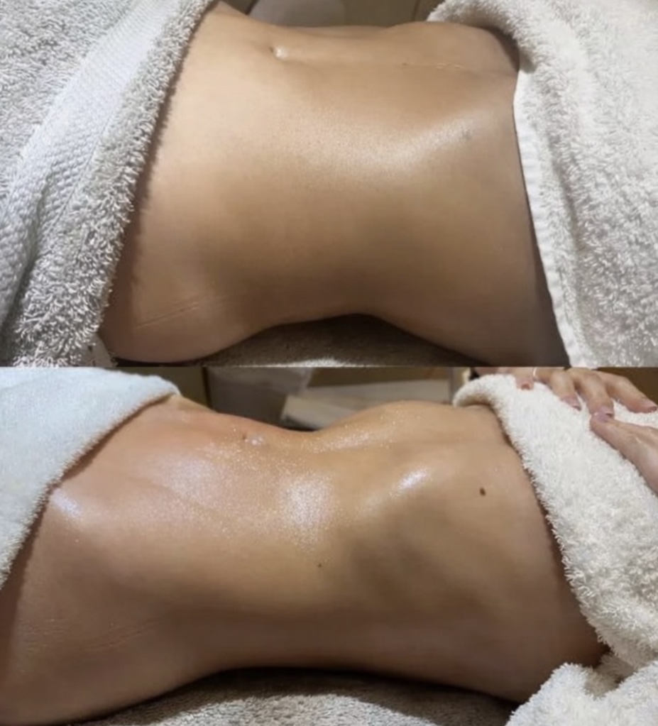 Frisco's Top Body Contour Specialist
